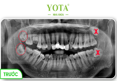 Nhổ liền 4 răng khôn cùng lúc có lợi ích và tác hại gì cùng lời khuyên từ bác sĩ